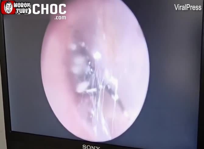 Video :She has a spider colony removed from her ear!